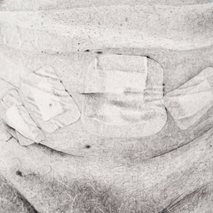 A detailed hand drawing by artist Herbert Stattler depicting a male torso one hour post-prostatectomy. The artwork captures the surgical reality of a bloated abdomen and five bandaged laparoscopic wounds with visible blood spots.